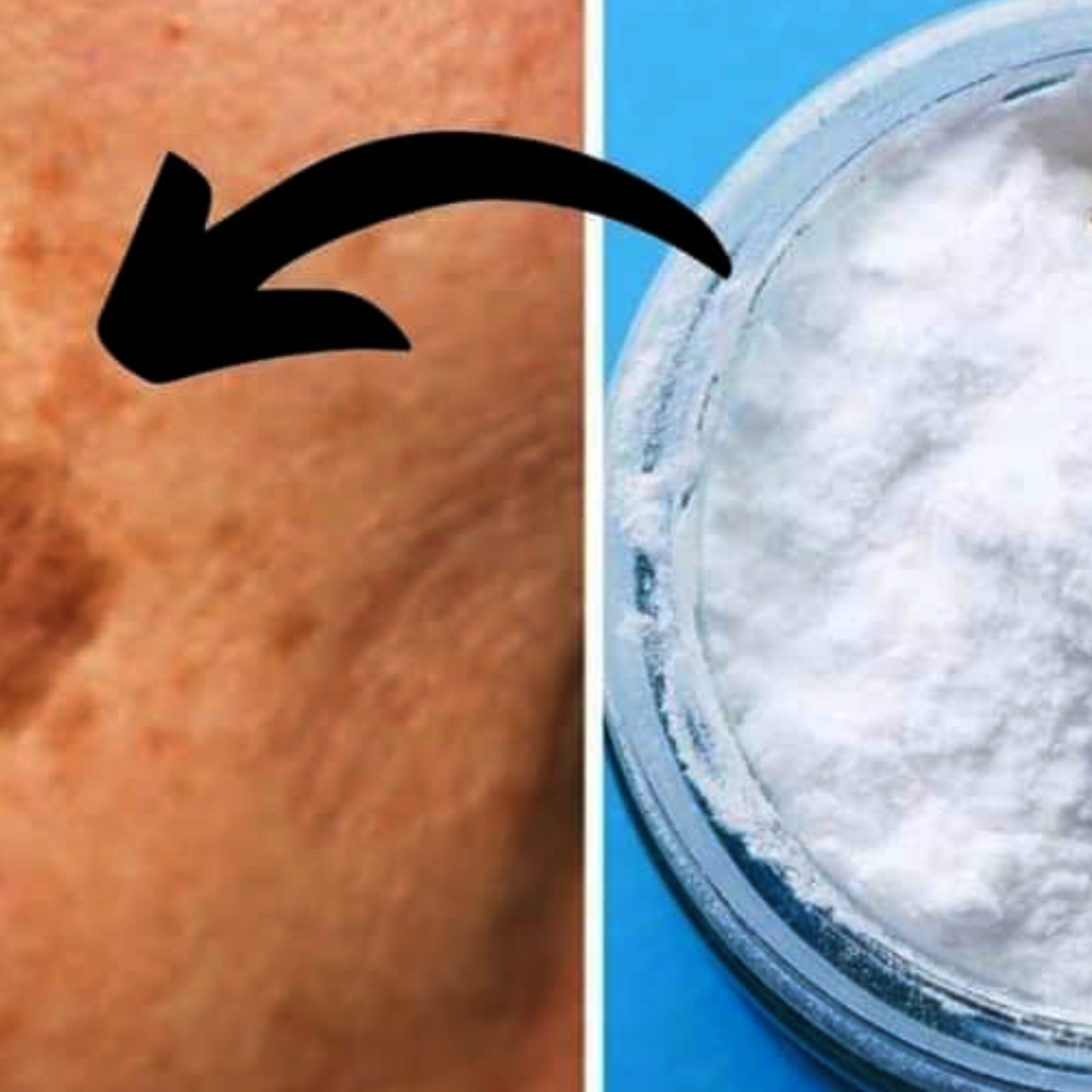 Baking soda can help get rid of age spots, acne, and blackheads! This is what you should do…