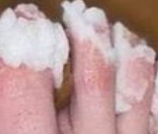 Natural Remedy for Nail Fungus: Effective Treatment for Quick Relief