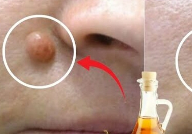 Apple Cider Vinegar: A Natural Solution for Removing Warts in 24 Hours